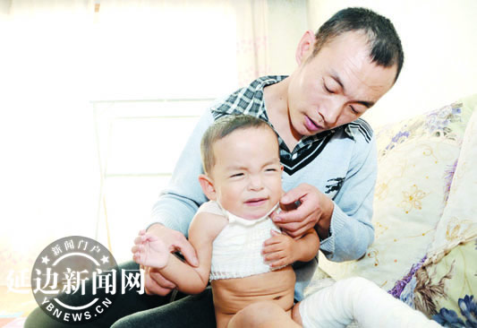 两岁半男孩打翻菜汤 全身烫伤面积达70%.jpg